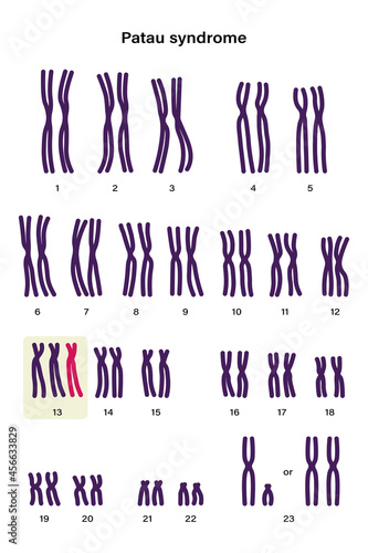 Human karyotype of Patau syndrome. Autosomal abnormalities. Patau syndrome have an extra copy of one of these chromosomes, chromosome 13. Trisomy 13, Genetic disorder 