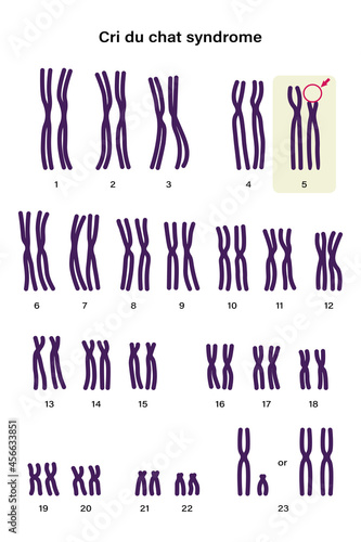 Human karyotype of Cri du chat syndrome. Autosomal abnormalities. A piece of chromosome 5 is missing