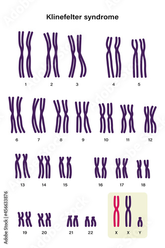 Human karyotype of Klinefelter syndrome. Klinefelter's, KS or XXY.