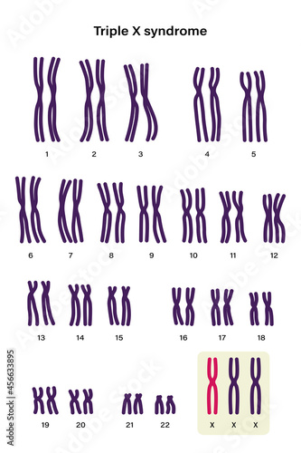 Human karyotype of Triple x syndrome. XXX. Female has an extra X chromosome.