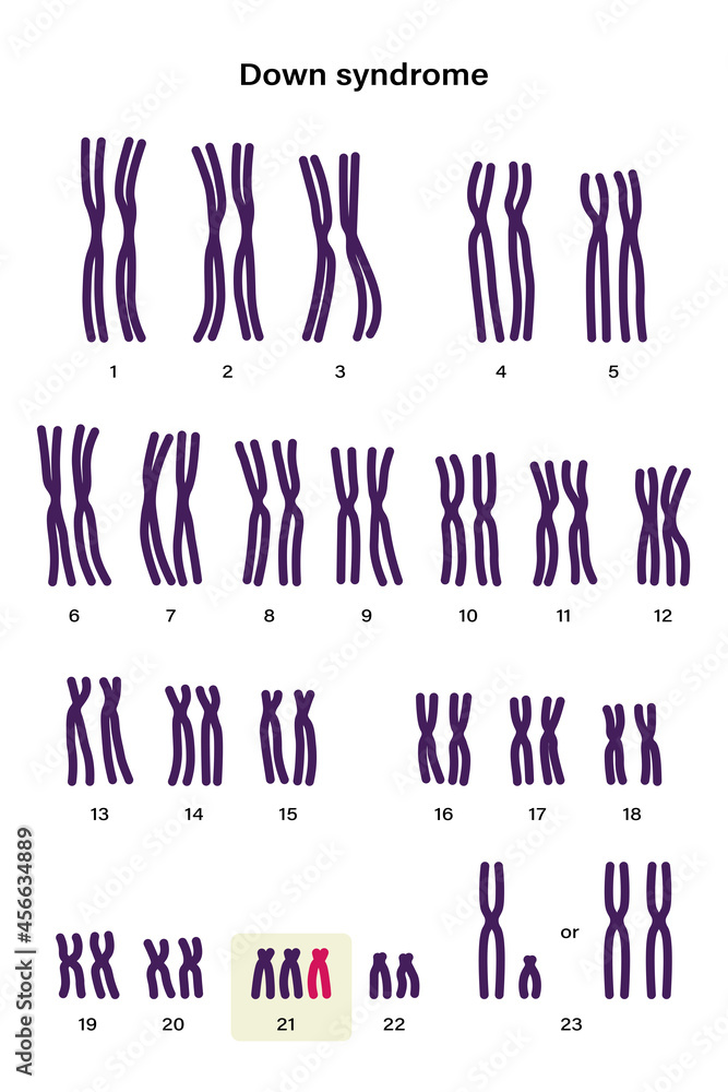 Human karyotype of Down syndrome. Autosomal abnormalities. Down