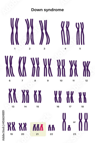 Human karyotype of Down syndrome. Autosomal abnormalities. Down syndrome have an extra copy of one of these chromosomes, chromosome 21. Trisomy 21. Genetic disorder