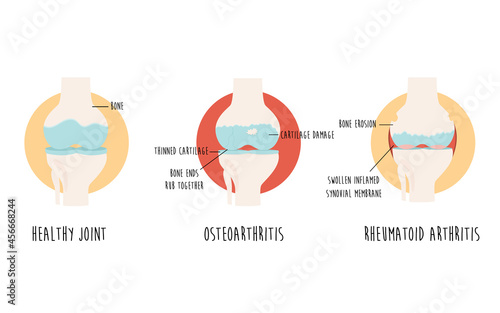 Vector diagram with healthy joint and joint with osteoarthritis, rheumatoid arthritis photo
