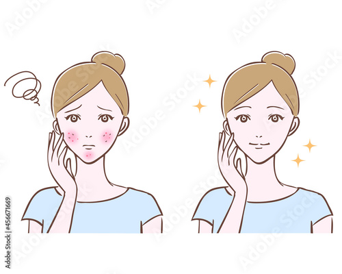 肌ラトブルのある女性と綺麗な肌の女性　ビフォーアフター