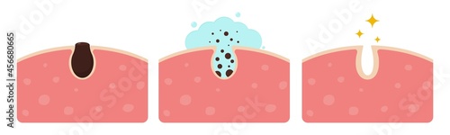 Cleaning clogged pores vector illustration. Skin care concept.