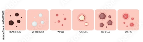 Types of acne. Acne on the skin and comedones on the face. Vector icons of acne on the skin. photo