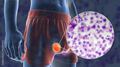 Schilderij op canvas Testicular cancer, 3D illustration