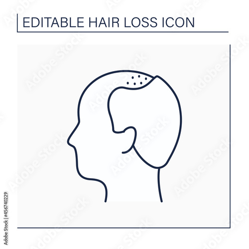 Hair loss line icon. Man loses hair. Male pattern baldness. Large bald area on front of scalp.Alopecia concept. Isolated vector illustration. Editable stroke