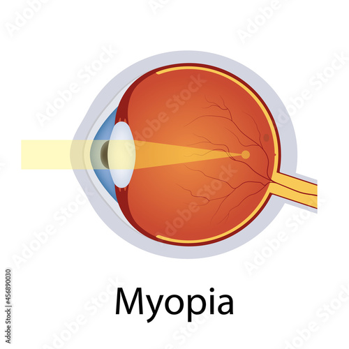 Myopia and Vision Disorders Illustration. Eyes Defect Concept. Detailed Anatomy Eyeball with Myopia Defect. Isolated Vector