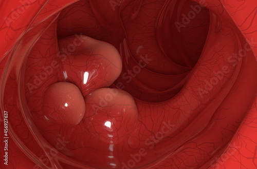 Large tumors on the colon wall in colorectal cancer closeup view 3d illustration photo