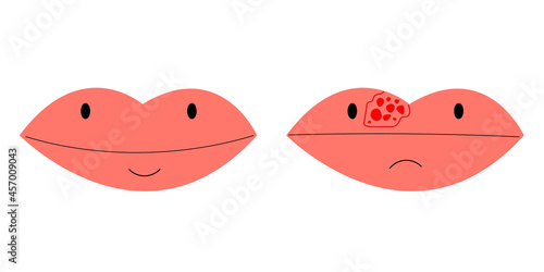 lips closeup with cold herpes, sore on the lip, vector illustration