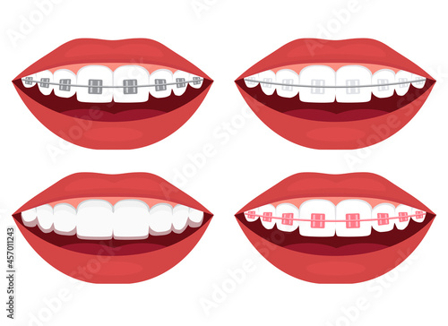 teeth alignment. Metal, ceramic, plastic, ligature and invisible braces photo