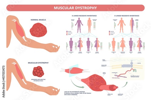 Muscle myopathy gene DNA cell damage Becker type Limb Girdle x linked Distal Emery loss Lack fibres tissue biceps arm spine weaken gait lumbar calf sign Gower lower exam fatigue Physical genetic stand