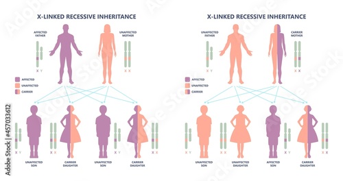 Muscle myopathy gene DNA cell damage Becker type Limb Girdle x linked Distal Emery loss Lack fibres tissue biceps arm spine weaken gait lumbar calf sign Gower lower exam fatigue Physical genetic stand