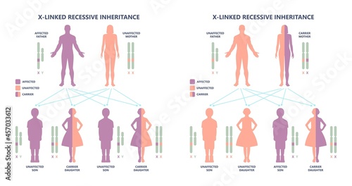 Muscle myopathy gene DNA cell damage Becker type Limb Girdle x linked Distal Emery loss Lack fibres tissue biceps arm spine weaken gait lumbar calf sign Gower lower exam fatigue Physical genetic stand photo