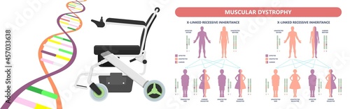 Muscle myopathy gene DNA cell damage Becker type Limb Girdle x linked Distal Emery loss Lack fibres tissue biceps arm spine weaken gait lumbar calf sign Gower lower exam fatigue Physical genetic stand