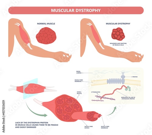 Muscle myopathy gene DNA cell damage Becker type Limb Girdle x linked Distal Emery loss Lack fibres tissue biceps arm spine weaken gait lumbar calf sign Gower lower exam fatigue Physical genetic stand