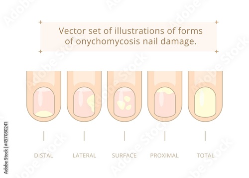 Vector set of illustrations of forms of onychomycosis nail damage. Distal, lateral, superficial, proximal and total forms