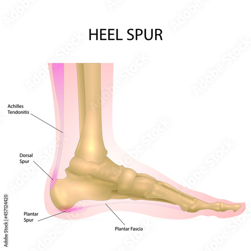 Heel spur on the foot. Anatomical representation.