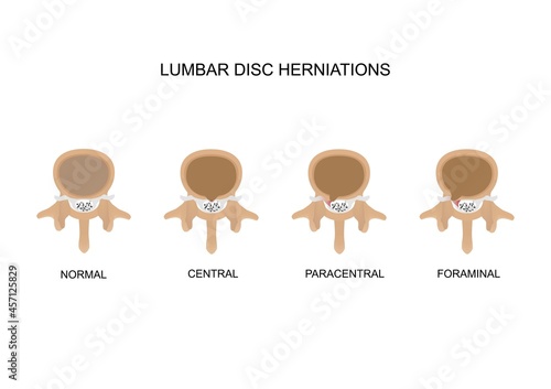 Vector illustration type of lumbar intervertebral disc herniations