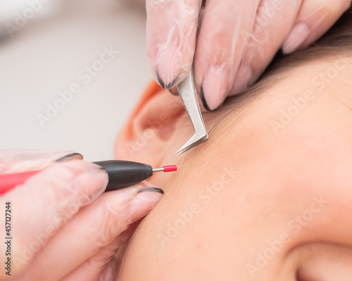 Woman on electro-epilation of the face. Hardware permanent removal of unwanted hair in the salon