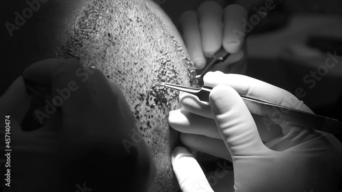 Close-up shot of hair transplantation procedure photo