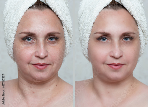 A pretty woman of middle age, over 40. Before and after the biorevitalization procedure. Successful intervention. Portrait. Close-up.