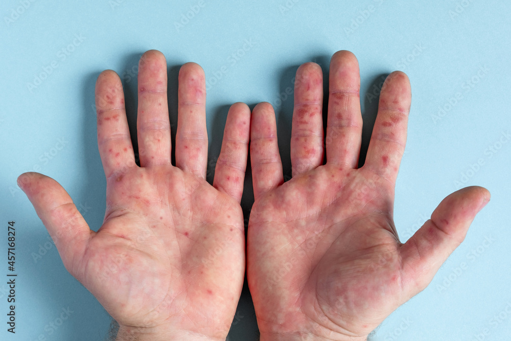 Painful rash, red spots blisters on the hand. Close up Allergy rash, human hands with dermatitis