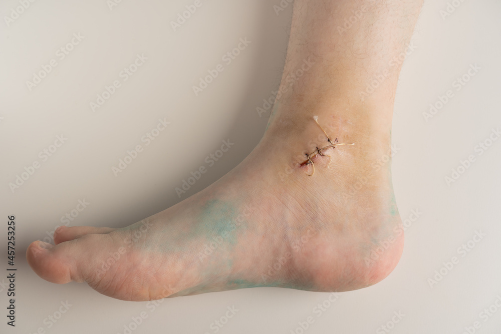 ankle wound with a suture after ankle fracture and removal of the cast. Stock Photo Adobe Stock