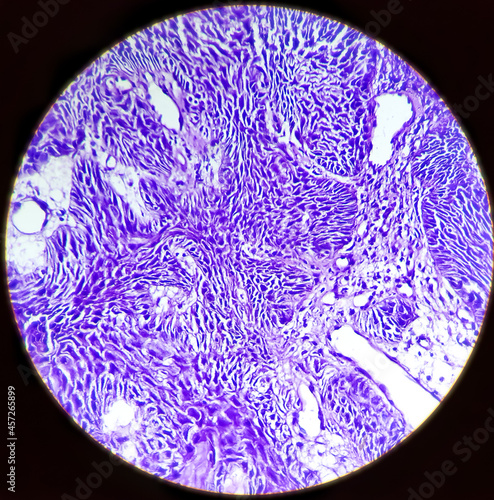 Cancer of Esophagus: Poorly differentiated adenocarcinoma in a patient. Tumor cells undermine the esophageal squamous mucosa, 40x view