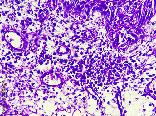 Cancer of Esophagus: Poorly differentiated adenocarcinoma in a patient. Tumor cells undermine the esophageal squamous mucosa, 100x view