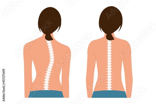 Good posture and bad posture. Chiropractic before after image. Scoliosis.Woman's body and backbone.