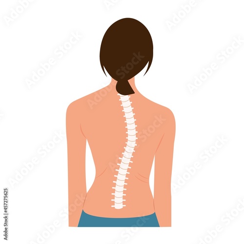 Scoliosis Spine Curve Anatomy, Posture Correction. Chiropractic treatment. Vector Illustration of back view woman representing   scoliosis and scale of curvature