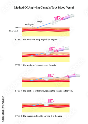 Method of applying cannula to a blood vessel