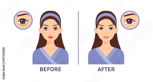 Young, Beautiful Woman with Dark Circles Under her Eyes. Icons. Treatment of Skin Around Eyes. Before and After. Health of Facial skin. Flat Cartoon style. White background. Vector illustration.