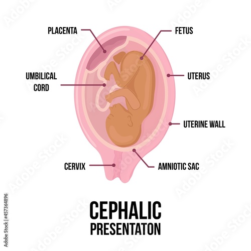 Latin arabian brown skin baby. Different wrong baby positions in uterus during pregnancy.