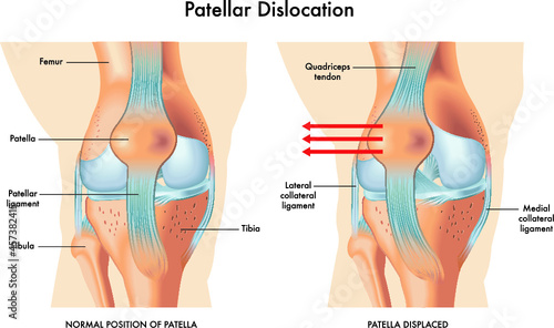 Medical illustration of symptoms of patellar dislocation, with annotations. photo