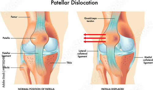 Medical illustration of symptoms of patellar dislocation, with annotations.