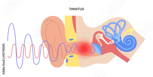 Tinnitus disease concept photo