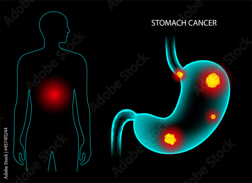 Stomach cancer anatomy