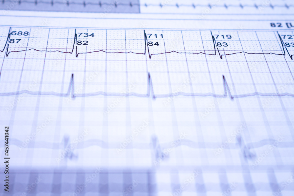 Electrocardiogram recorded on graph paper. Study of the human heart. Electrocardiogram recorded on graph paper. Study of the human heart.