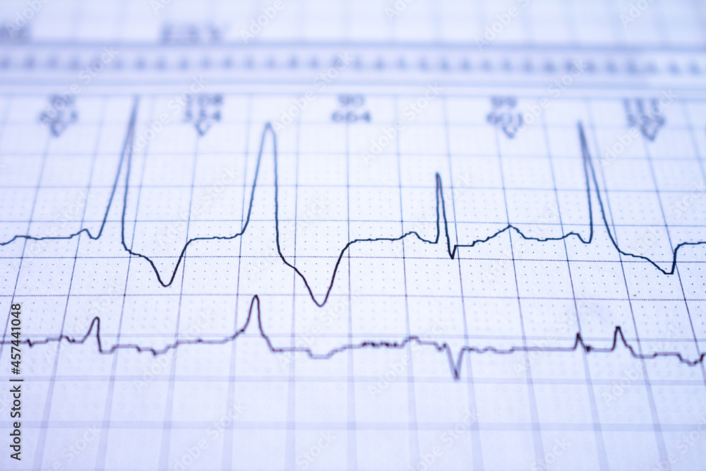 Electrocardiogram recorded on graph paper. Study of the human heart. Electrocardiogram recorded on graph paper. Study of the human heart.
