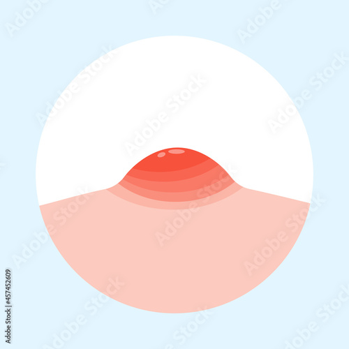 Flat vector illustration of pimple on skin. Pimple on face.
