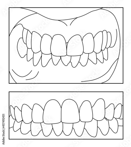 Teeth, denture. Perfect bite and smile schemes. Dentist, dentistry. Sketch line black and white vector illustration.