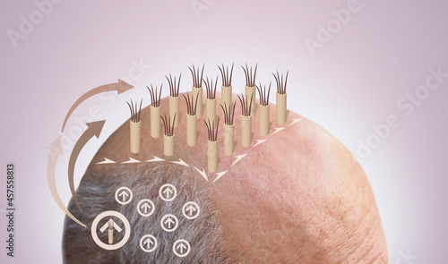 Methods of hair transplantation fut vs fue with infographic elements of illustration. photo