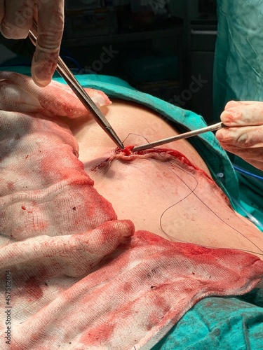 Suturing in surgery