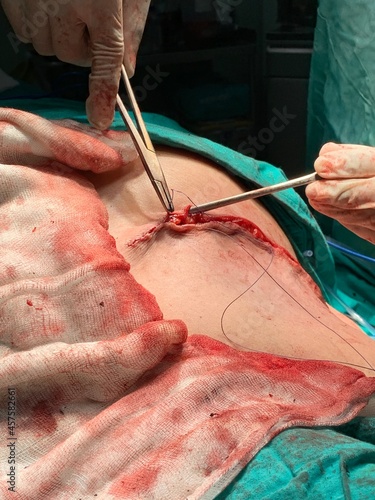 Suturing in surgery
