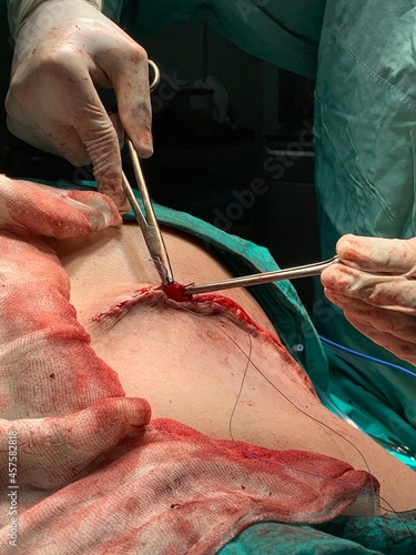 Suturing in surgery