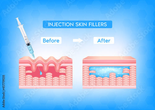 Injection filler injection under the skin on face with wrinkle dermal layer before and after. Facial hyaluronic acid (HA-Filler). Medical and beauty concept. Vector EPS10 illustration.
