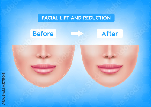 White female face before after plastic surgery jaw reduction and botox injections facial lift and reduction. For advertising of plastic surgery. Medical and beauty concept. Vector EPS10 illustration.